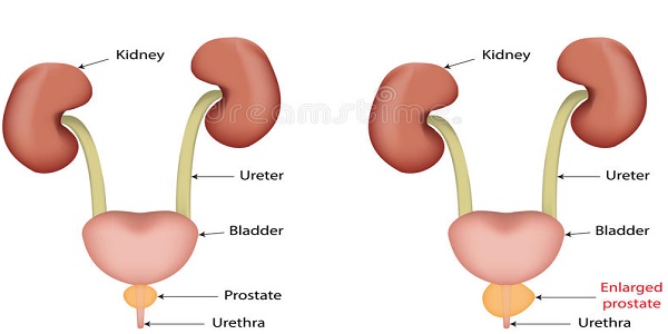 علاج تضخم البروستاتا , التخلص من مرض البروستاتا