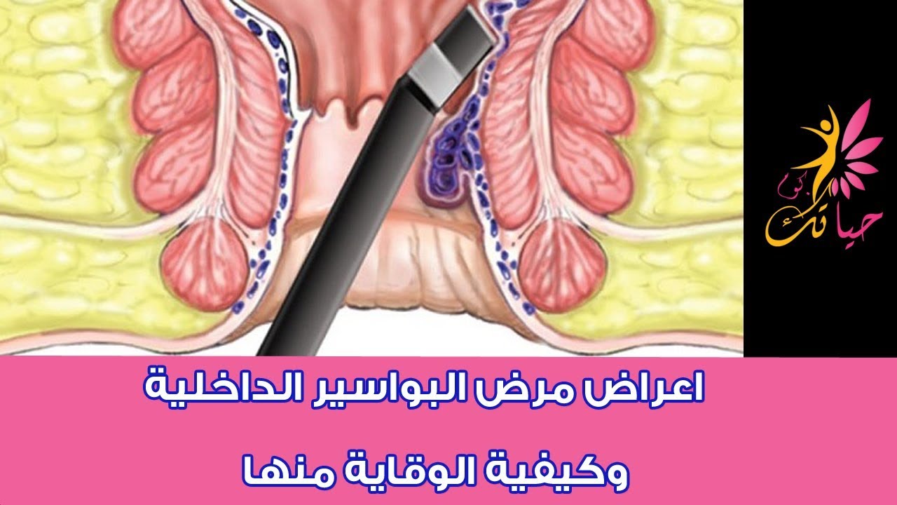 اعراض البواسير 2347 2