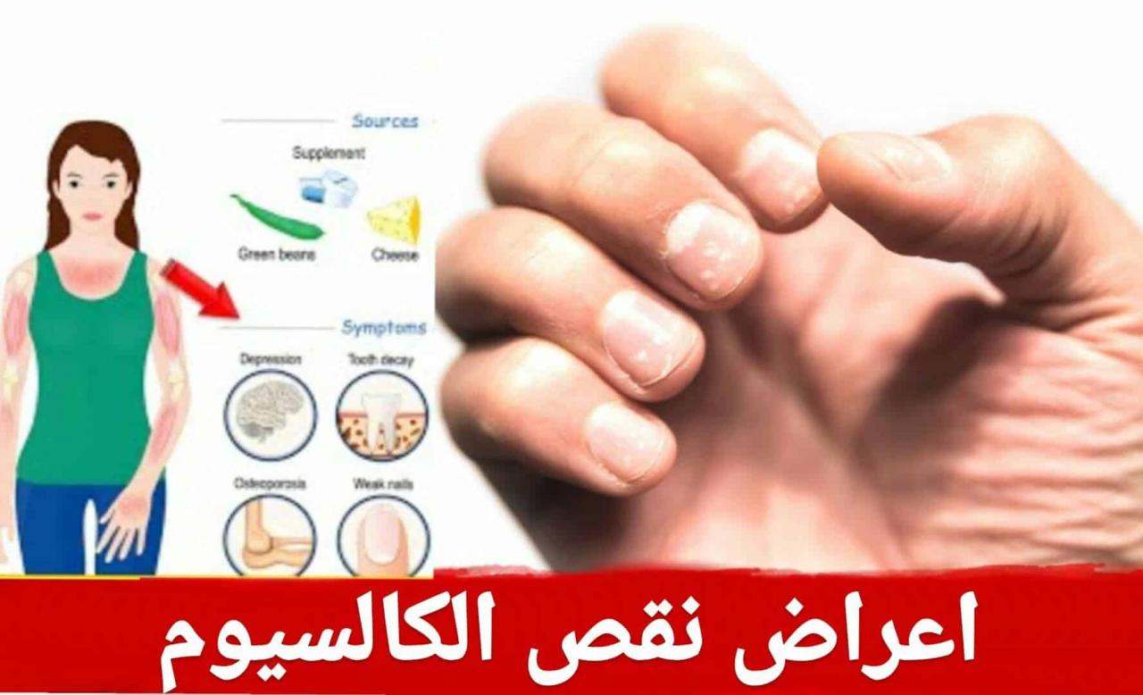 اعراض نقص الكالسيوم , اضرار نقص الكالسيوم