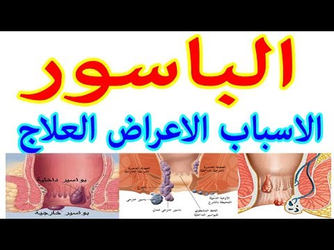 علاج الناسور - تعرف علي علاج الناسور 5941 1