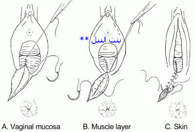 عمليات تجميل المهبل بالصور قبل وبعد - عمليات تجميل للمهبل 4096 7