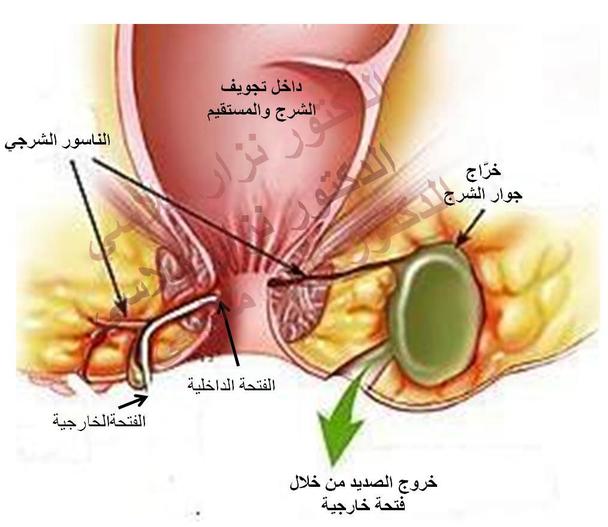 ما هو الناسور , تعرف علي اسباب الناسور الشرجي واعراضه للوقايه منه