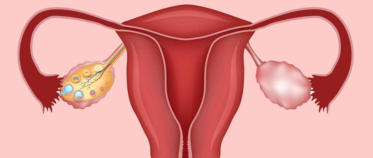 ماهي اعراض تكيس المبايض - طريقه مذهلة لمعرف تكيسات المبايض 1682 11