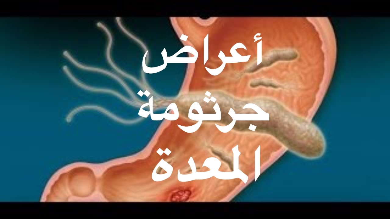 اعراض جرثومة المعدة - ما هى اسباب واعراض جرثومة المعدة 5503 3