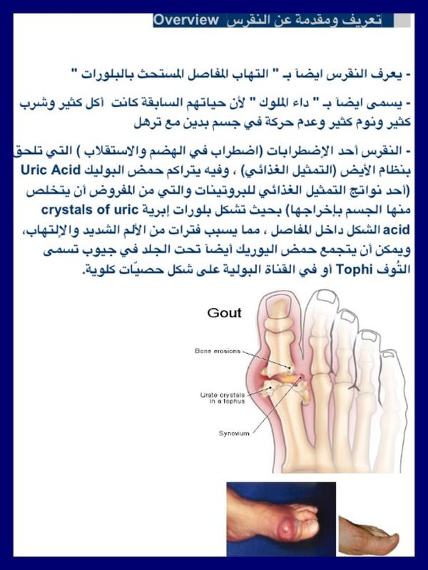 ما هو مرض النقرس - تعرف على مرض النقرس واعراضه و طرق علاجه 5731 5