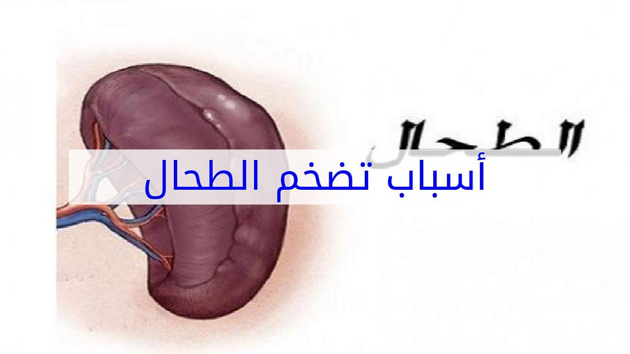 علاج تضخم الطحال - كيف نعالج تضحم الطحال بسهولة 12298 2