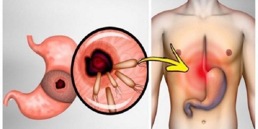 اعراض جرثومة المعدة - ما هى اسباب واعراض جرثومة المعدة 5503 1