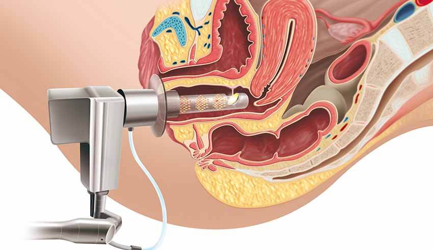 عمليات تجميل المهبل بالصور قبل وبعد - عمليات تجميل للمهبل 4096 3