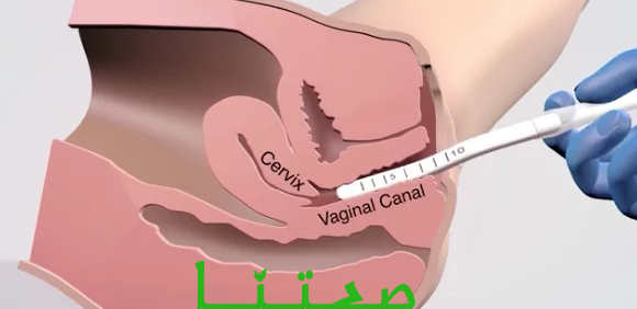 عمليات تجميل المهبل بالصور قبل وبعد - عمليات تجميل للمهبل 4096 1