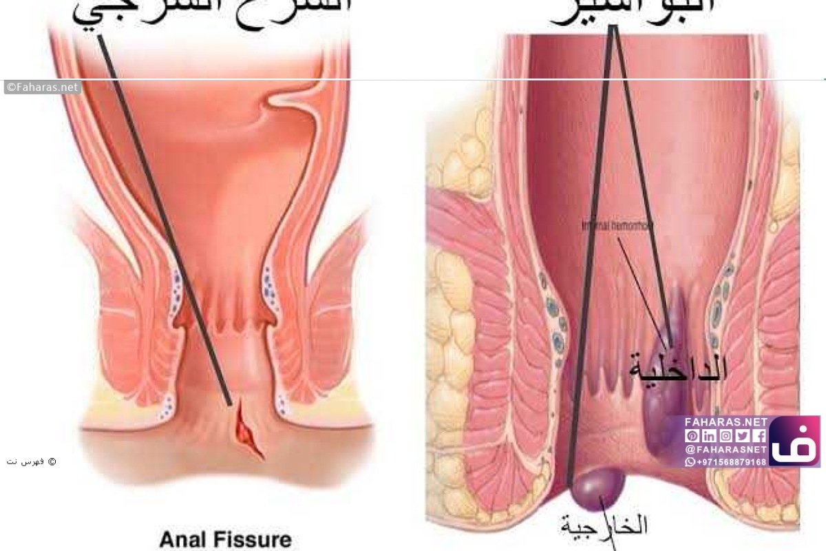 اعراض البواسير 2347 3