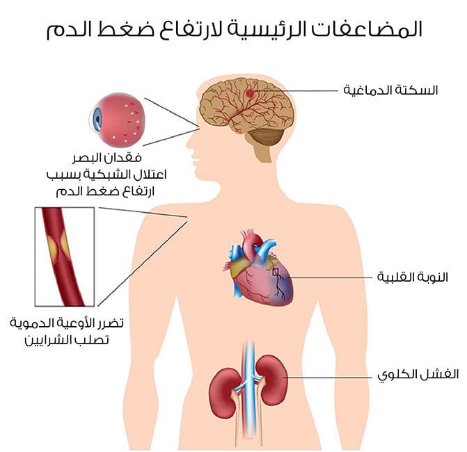 اسباب ارتفاع ضغط الدم،خطر الاصابه بارتفاع ضغط الدم وعلاجه 3560 1