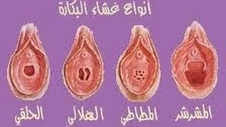 كيفيه معرفه البنت العذراء بالصور - كشف العذوريه 3947 4