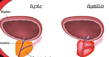 اسباب تضخم البروستاتا 2829 1