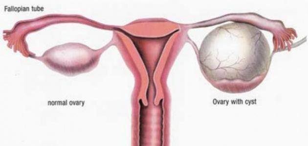علاج التكيس , تكيسات المبايض اعراضها وعلاجها