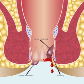مرض البواسير , لا يعرف عنه الكثير ما هو