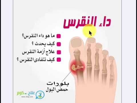 ما هو مرض النقرس - تعرف على مرض النقرس واعراضه و طرق علاجه 0 96