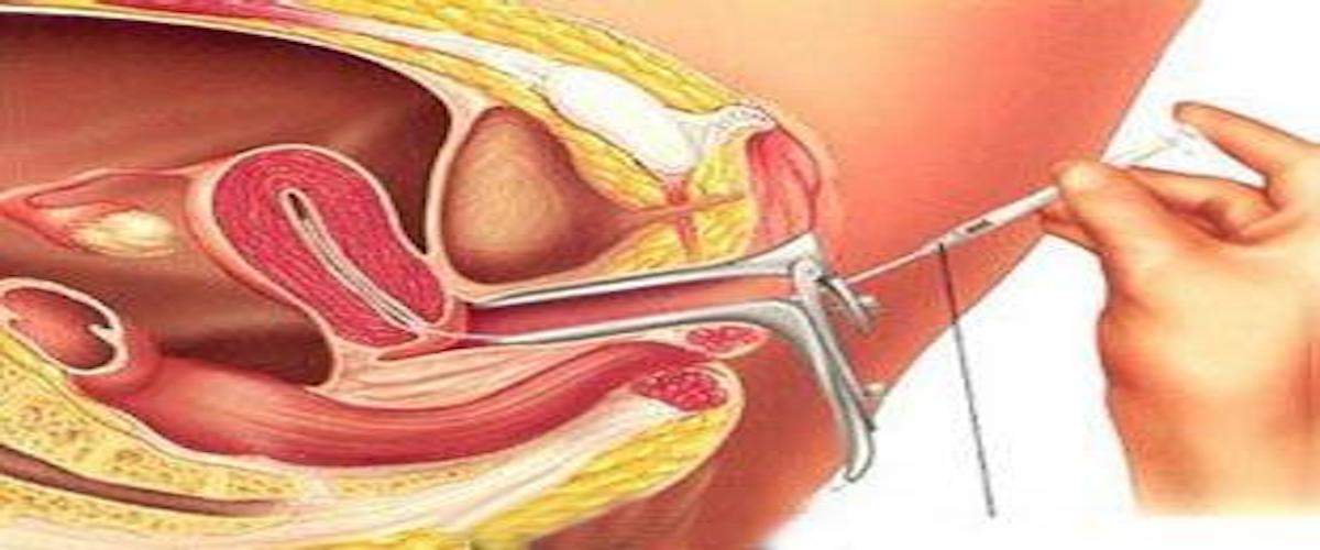 عمليات تجميل المهبل بالصور قبل وبعد - عمليات تجميل للمهبل 4096 2