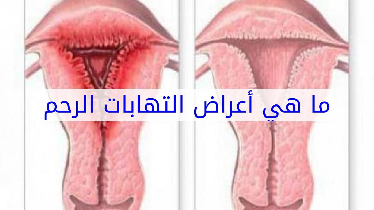 حبة في عنق الرحم - اعراض التهابات عنق الرحم 12875 1