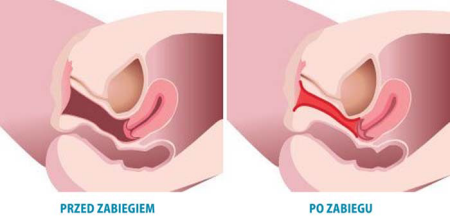 عمليات تجميل المهبل بالصور قبل وبعد - عمليات تجميل للمهبل 4096