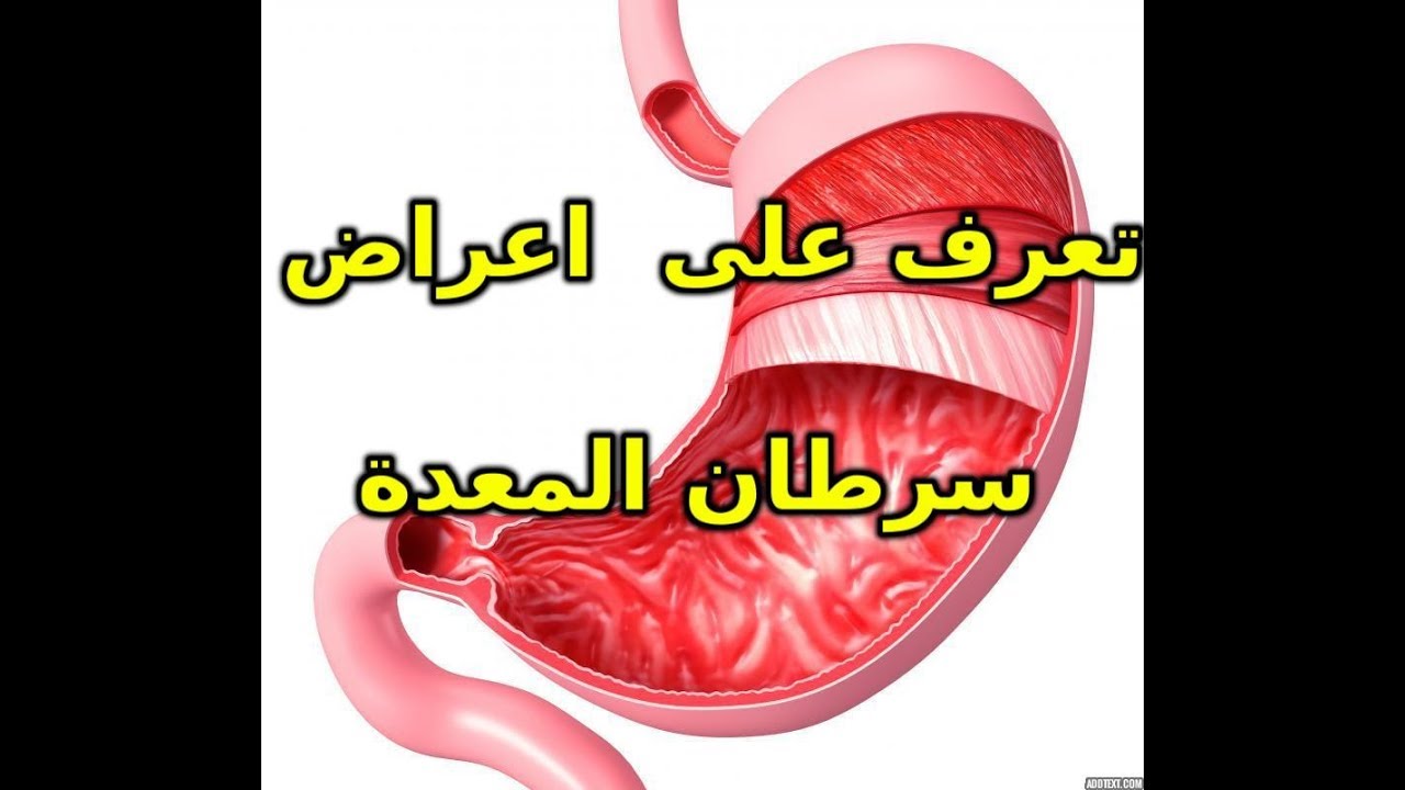 اعراض سرطان المعدة , اشهر علامات مرض السرطان