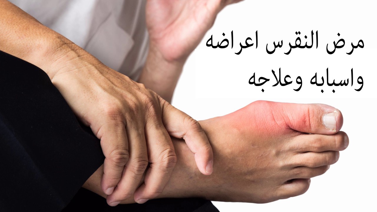 ما هو مرض النقرس - تعرف على مرض النقرس واعراضه و طرق علاجه 5731