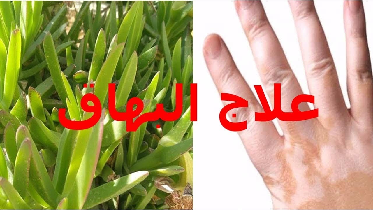 علاج البرص , كيفيه التخلص من مرض البرص