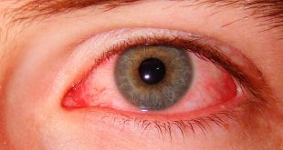 5601 3 العين الحمراء - اذا تعرضت عيناك للاحمرار لا تستهون بها رفاعي ماهتار