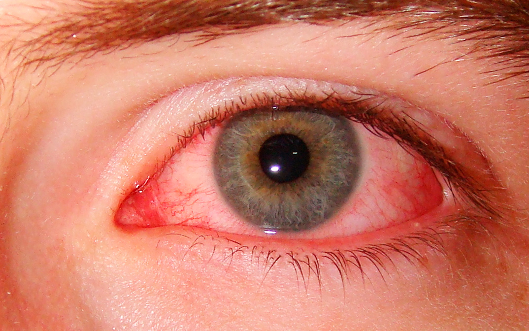 سبب العيون الحمراء