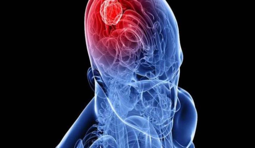 589 1 اعراض سرطان الدماغ , الكشف المبكر عن سرطان الدماغ وعلاجه جليل حميدة