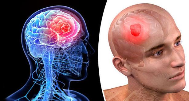 589 2 اعراض سرطان الدماغ , الكشف المبكر عن سرطان الدماغ وعلاجه جليل حميدة
