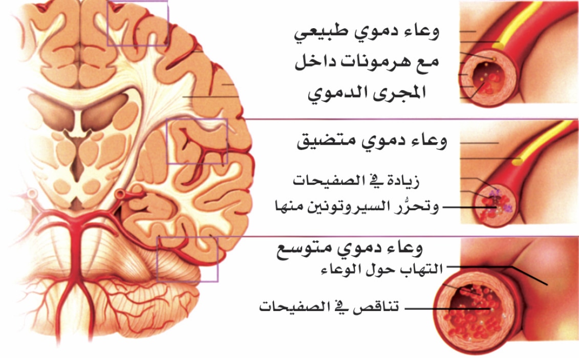 مرض الشقيقة - اعراض وعلاج مرض الشقيقة