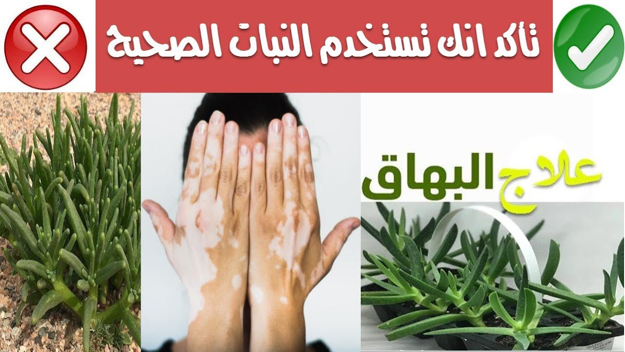 علاج البهاق بالاعشاب