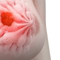17179 10 اسباب سرطان الثدي- ماهي اعراض واسباب سرطان الثدي وطرق علاجه محبتكم عزيزه
