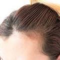 17056 1 طريقة علاج تساقط الشعر نهائيا وتكثيفه ، افضل علاج لتساقط الشعر مجرب رفاعي ماهتار
